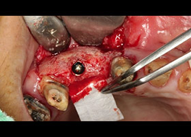 proimages/case/3D-01.png proimages/Case/dentalimplant/08/serious5.jpg