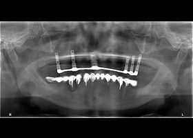 proimages/case/3D-01.png proimages/Case/dentalimplant/09/01/HON01.jpg