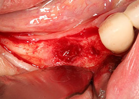 proimages/case/3D-01.png proimages/Case/dentalimplant/09/01/HON03-2.jpg