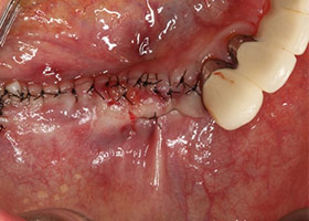 proimages/case/3D-01.png proimages/Case/dentalimplant/09/01/HON04-1.jpg