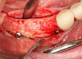 proimages/case/3D-01.png proimages/Case/dentalimplant/09/01/HON05-2.jpg
