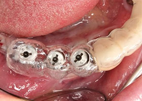 proimages/case/3D-01.png proimages/Case/dentalimplant/09/01/HON06-2.jpg