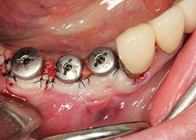 proimages/case/3D-01.png proimages/Case/dentalimplant/09/01/HON07-1.jpg