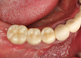 proimages/case/3D-01.png proimages/Case/dentalimplant/09/01/HON08-1.jpg
