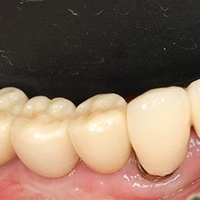 角質化牙齦增生手術