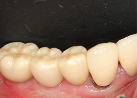proimages/case/3D-01.png proimages/Case/dentalimplant/09/01/HON08-2.jpg
