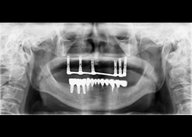 proimages/case/3D-01.png proimages/Case/dentalimplant/09/01/HON09.jpg