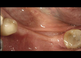 proimages/case/3D-01.png proimages/Case/dentalimplant/09/02/Horny1.jpg
