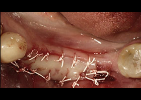 proimages/case/3D-01.png proimages/Case/dentalimplant/09/02/Horny2.jpg