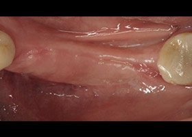 proimages/case/3D-01.png proimages/Case/dentalimplant/09/02/Horny3.jpg
