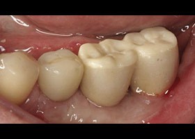 proimages/case/3D-01.png proimages/Case/dentalimplant/09/02/Horny5.jpg