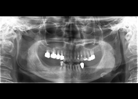 proimages/case/3D-01.png proimages/Case/dentalimplant/10/01/bite01.jpg