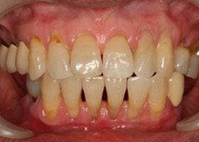 proimages/case/3D-01.png proimages/Case/dentalimplant/10/01/bite02.jpg