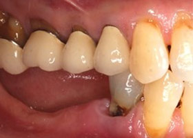 proimages/case/3D-01.png proimages/Case/dentalimplant/10/01/bite03.jpg