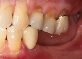 proimages/case/3D-01.png proimages/Case/dentalimplant/10/01/bite04.jpg