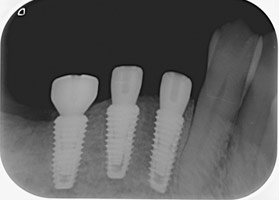 proimages/case/3D-01.png proimages/Case/dentalimplant/10/01/bite05.jpg