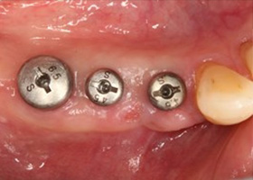 proimages/case/3D-01.png proimages/Case/dentalimplant/10/01/bite07.jpg