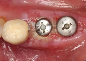 proimages/case/3D-01.png proimages/Case/dentalimplant/10/01/bite08.jpg