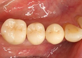 proimages/case/3D-01.png proimages/Case/dentalimplant/10/01/bite09.jpg