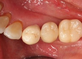 proimages/case/3D-01.png proimages/Case/dentalimplant/10/01/bite10.jpg