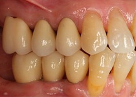proimages/case/3D-01.png proimages/Case/dentalimplant/10/01/bite11.jpg