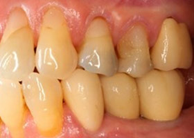 proimages/case/3D-01.png proimages/Case/dentalimplant/10/01/bite12.jpg