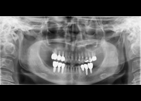 proimages/case/3D-01.png proimages/Case/dentalimplant/10/01/bite13.jpg