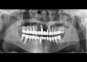 proimages/Case/dentalimplant/10/02/after01.jpg