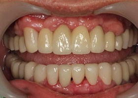 proimages/Case/dentalimplant/10/02/after02.jpg