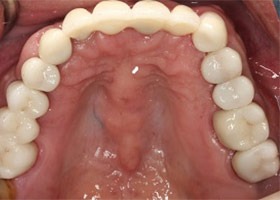 proimages/Case/dentalimplant/10/02/after03.jpg