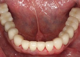 proimages/Case/dentalimplant/10/02/after04.jpg