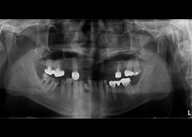 proimages/Case/dentalimplant/10/02/before01.jpg