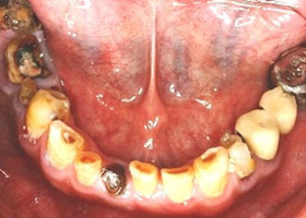 proimages/Case/dentalimplant/10/02/before03.jpg