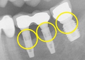 proimages/case/3D-01.png proimages/Case/dentalimplant/11/01/save-defeat01-1.jpg