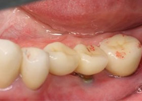 proimages/case/3D-01.png proimages/Case/dentalimplant/11/01/save-defeat01.jpg