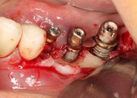 proimages/case/3D-01.png proimages/Case/dentalimplant/11/01/save-defeat02-1.jpg