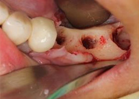 proimages/case/3D-01.png proimages/Case/dentalimplant/11/01/save-defeat02-2.jpg
