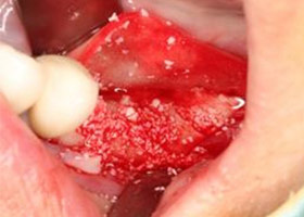 proimages/case/3D-01.png proimages/Case/dentalimplant/11/01/save-defeat03-1.jpg