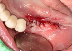 proimages/case/3D-01.png proimages/Case/dentalimplant/11/01/save-defeat03-2.jpg