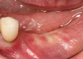 proimages/case/3D-01.png proimages/Case/dentalimplant/11/01/save-defeat04-1.jpg