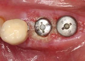 proimages/case/3D-01.png proimages/Case/dentalimplant/11/01/save-defeat04-2.jpg