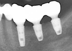 proimages/case/3D-01.png proimages/Case/dentalimplant/11/01/save-defeat05-1.jpg