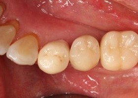 proimages/case/3D-01.png proimages/Case/dentalimplant/11/01/save-defeat05-2.jpg